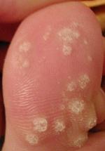 Wart